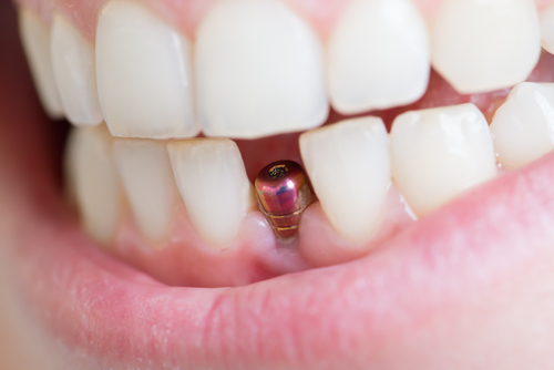 What Do Dental Implants Look Like?